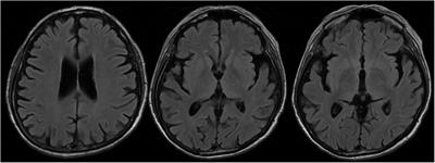 18F-FDG PET/CT as a molecular biomarker in the diagnosis of amyotrophic lateral sclerosis associated with prostate cancer and progressive supranuclear palsy: A case report